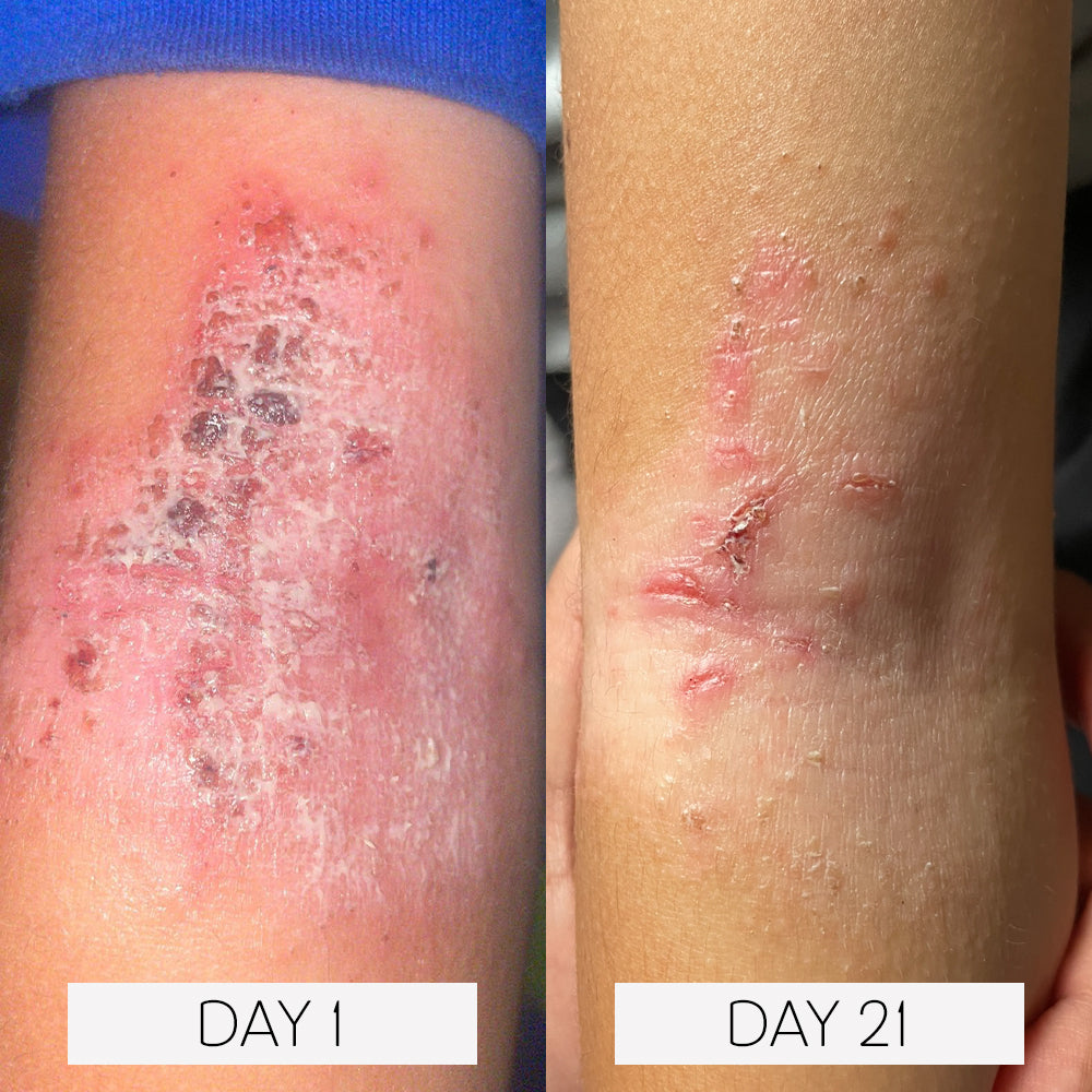 Eczema Moisturizing Treatment Lotion
